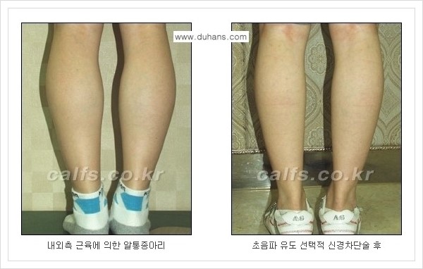 [두한성형외과 경쟁력 멀티종아리성형] - [나에게 맞는 종아리성형 방법의 종류 안내 2.] 관련 이미지 4