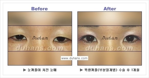 [두한성형외과 경쟁력 눈성형] - [퀵쌍꺼풀 수술 전후 정보 안내 ②] 관련 이미지 12