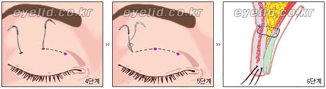 [두한성형외과 눈성형] - [쌍꺼풀수술의 절개법, 매몰법] 관련 이미지 8