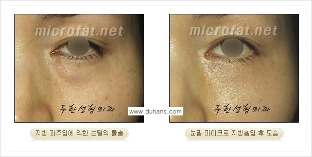 [두한성형외과 겨울엔 지방흡입을] - [볼살, 눈밑, 턱선의 초음파 미세지방흡입 2.] 관련 이미지 15