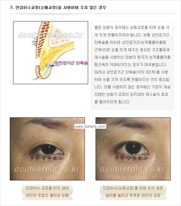 [두한성형외과 경쟁력 쌍꺼풀 재수술(눈재수술)] - [쌍꺼풀 재수술(눈재수술)의 실패의 원인 분석] 관련 이미지 6