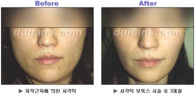 [Duhan Plastic Surgery Clinic Aesthetic Procedures] - [Square Jaw Botox] image 26