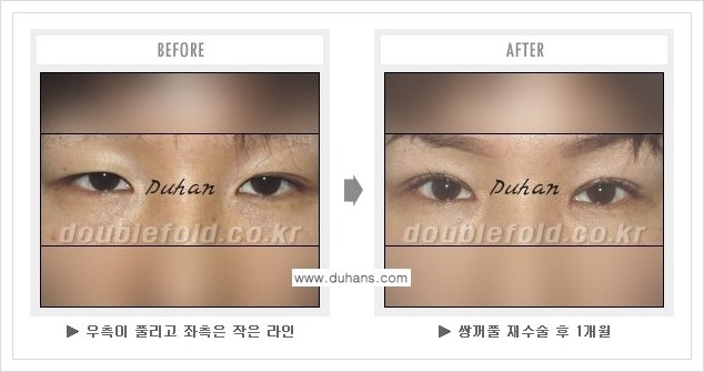 [두한성형외과] - [쌍꺼풀 재수술 푸는 수술을 하고 내원했을 경우의 문제] 관련 이미지 5