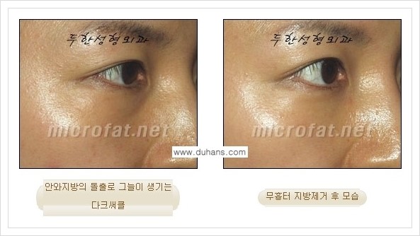 [두한성형외과 경쟁력 눈밑성형] - [눈밑지방제거, 눈위지방제거 안내 2.] 관련 이미지 15