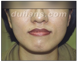 [Duhan Plastic Surgery Clinic Aesthetic Procedures] - [Square Jaw Botox] image 16