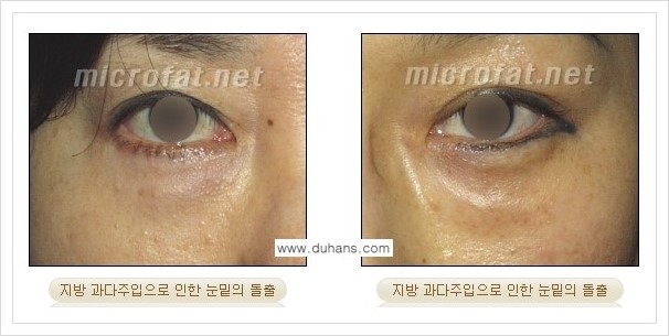 ​[두한성형외과 경쟁력 미세지방이식] - [타병원에서의 미세지방이식 부작용 종류와 문제점 안내] 관련 이미지 4