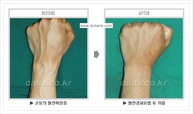 [두한성형외과 정맥류 치료] - [손, 팔 정맥확장증 사진자료 안내 ①] 관련 이미지 8