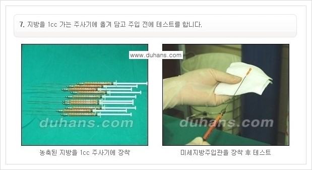 [두한성형외과 경쟁력 미세지방이식] - [부드럽고 아름다운 얼굴선 만들기, 얼굴 미세지방이식 과정 안내] 관련 이미지 6