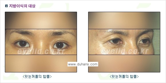 [두한성형외과 NO.1 눈성형] - [눈꺼풀 지방이식 관련 흔한 질문과 답변] 관련 이미지 1