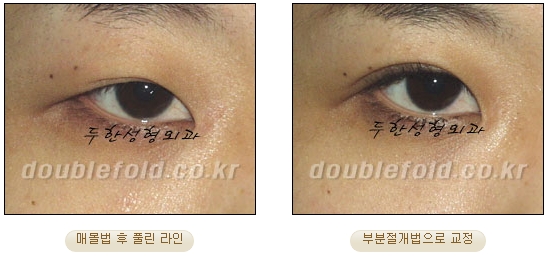 [두한성형외과 쌍커풀수술] - [눈성형 방법에 대한 자주하는 질문과 답변] 관련 이미지 52