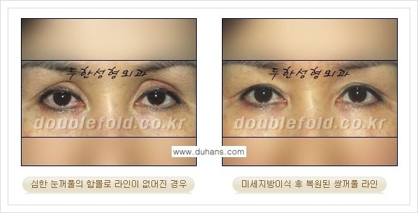 [두한성형외과 경쟁력 쌍꺼풀 재수술(극한 재수술)] - [라인이 풀렸을 경우의 쌍꺼풀 재수술 안내 ②] 관련 이미지 7