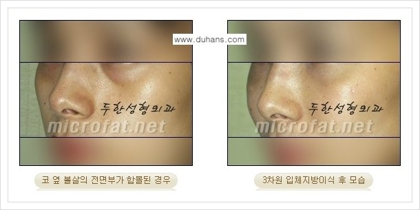 [두한성형외과 경쟁력 미세지방이식] - [귀족수술과 인디언밴드 교정 안내] 관련 이미지 12