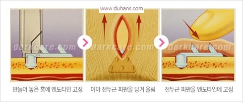 [두한성형외과 경쟁력 주름성형] - [주름제거와 볼륨을 갖게하는 엔도타인 리프팅] 관련 이미지 19