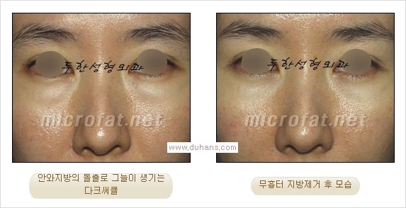 ⁠⁠[두한성형외과 경쟁력 안검성형] - [젊은 눈매를 위한 윗눈꺼풀 지방제거, 눈밑 지방제거] 관련 이미지 23