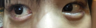 [Duhan Plastic Surgery Dark Circles] - [Under-Eye Dark Circle 5-Step Solution] image 45