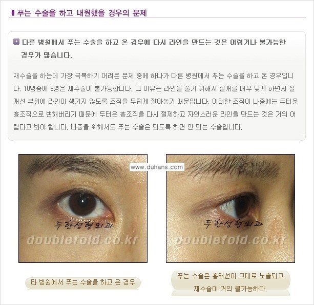 [두한성형외과 경쟁력 있는 쌍꺼풀 재수술] - [극복해야 할 극한의 상황과 문제들] 관련 이미지 12