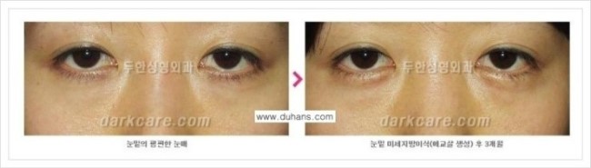 [두한성형외과 경쟁력 눈밑성형] - [눈밑애교살 시술을 위한 미세지방이식] 관련 이미지 20