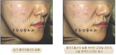 [Duhan Plastic Surgery Face Autologous Fat Grafting] - [Noble Surgery and Indian Band Fat Grafting] image 9