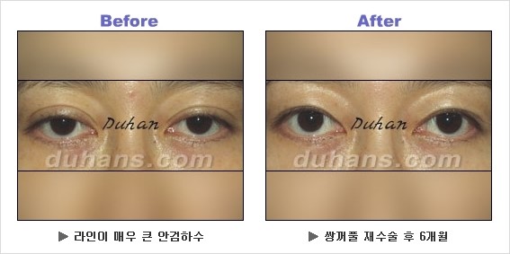 [두한성형외과 경쟁력 쌍꺼풀 재수술] - [안검하수 성형 흔한 질문과 답변 모음] 관련 이미지 3