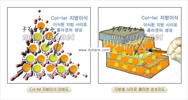 [두한성형외과] - [두한 지방이식의 자부심 콜펫(Col-fat)지방이식] 관련 이미지 2