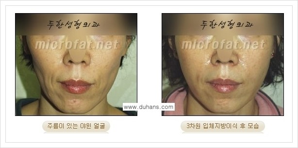 ⁠⁠[두한성형외과 경쟁력 볼살지방이식] - [심하게 야윈 주름이 있는 얼굴, 역삼각형 협소한 얼굴, 광대뼈가 돌출되어 보이는 경우 안내] 관련 이미지 11