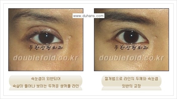 [두한성형외과 경쟁력 쌍꺼풀 재수술, 극한 재수술] - [속눈썹 외반 수술 방법 안내] 관련 이미지 6