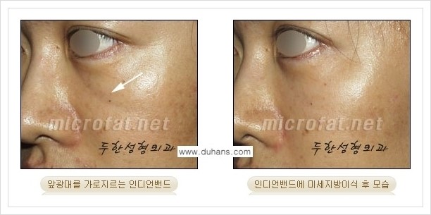 [두한성형외과 경쟁력 미세지방이식] - [귀족수술과 인디언밴드(앞광대주름) 미세지방이식] 관련 이미지 20