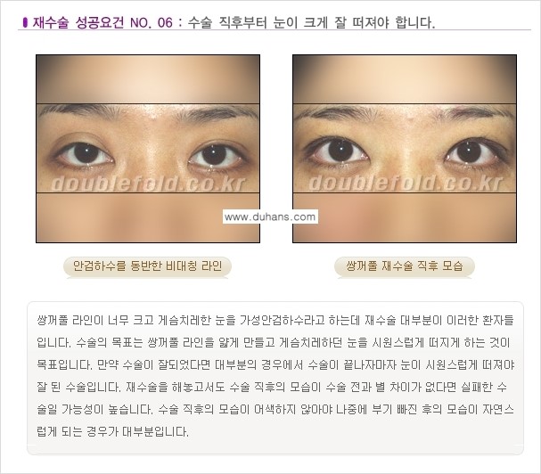 [두한성형외과 무한 경쟁력 "극한 눈(쌍꺼풀) 재수술"] - [극한 눈(쌍꺼풀) 재수술 성공요건!] 관련 이미지 7