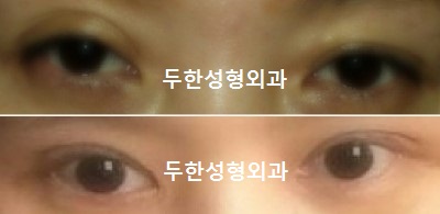 [Duhan Plastic Surgery Double Eyelid Revision] - [Reducing the Double Eyelid Line] image 36