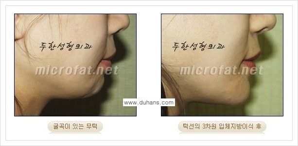 [두한성형외과 경쟁력 미세지방이식] - [무턱교정, 턱 미세지방이식 안내 2.] 관련 이미지 15