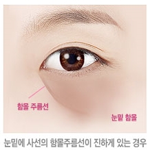두한성형외과 눈밑수술 - 다크서클 수술 전후 관리 안내 관련 이미지 102
