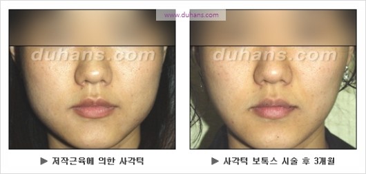 [두한성형외과 경쟁력 안면윤곽 성형 리더] - [완변한 V 라인! 턱 미세지방이식, 볼살 미세지방이식, 사각턱 보톡스 안내] 관련 이미지 29