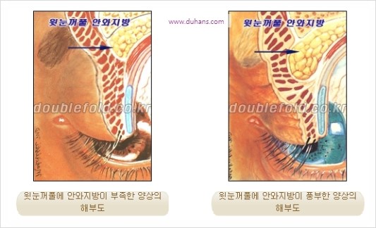 [두한성형외과 경쟁력 눈성형] - [극한 재수술, 함몰된 눈꺼풀 라인교정, 안검하수(졸리운 눈매)] 관련 이미지 36
