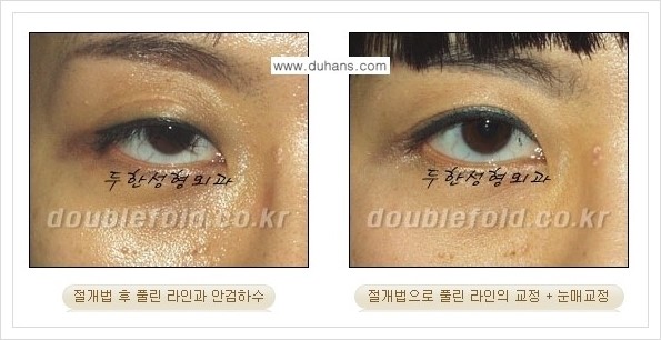[두한성형외과 경쟁력 쌍꺼풀 재수술, 극한 눈재수술] - [풀린 쌍꺼풀 라인 교정수술 안내] 관련 이미지 5