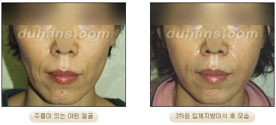 [두한성형외과 얼굴자가지방이식] - [볼살, 이마, 측두부] 관련 이미지 12