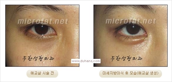 [두한성형외과 경쟁력 눈밑성형] - [타 병원 필러 애교살 시술 부작용을 미세지방이식으로 교정] 관련 이미지 30