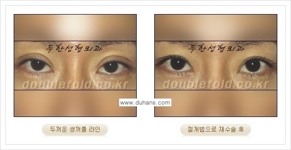 [두한성형외과 경쟁력 쌍꺼풀 재수술] - [두껍고 어색한 라인 교정하는 방법 안내 2.] 관련 이미지 6