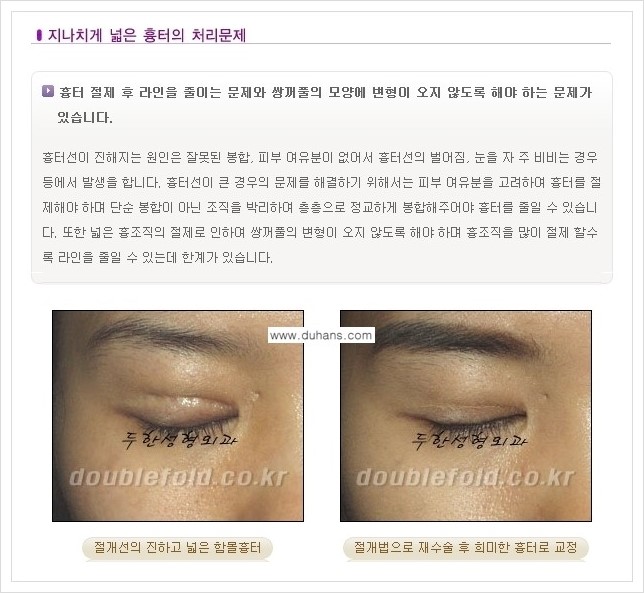 [두한성형외과 경쟁력 쌍꺼풀 재수술, 극한 재수술] - [재수술에서 극복해야 할 극한의 상황과 문제들 안내] 관련 이미지 2