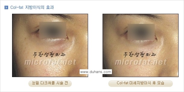 [두한성형외과 경쟁력 미세지방이식] - [Col-fat(콜펫) 지방이식의 특징과 차이점 안내] 관련 이미지 5