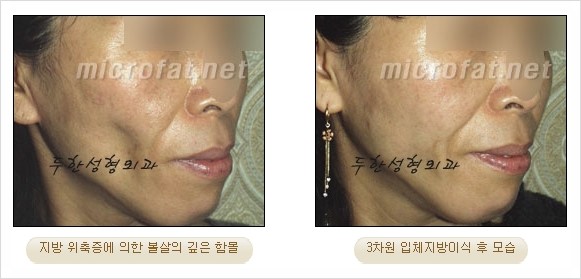 [두한성형외과 경쟁력 지방이식 리더] - [Col-fat(콜펫)지방이식, 3차원 입체지방이식, 2차원 평면지방이식] 관련 이미지 51