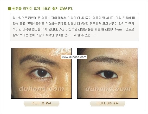 [두한성형외과 경쟁력 눈성형] - [아름답고 자연스러운 눈매, 매력적인 쌍꺼풀 안내] 관련 이미지 1