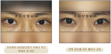 [Duhan Plastic Surgery Eye Surgery] - [Asymmetric Line, Eyelash Eversion, Deep Fixation] image 17