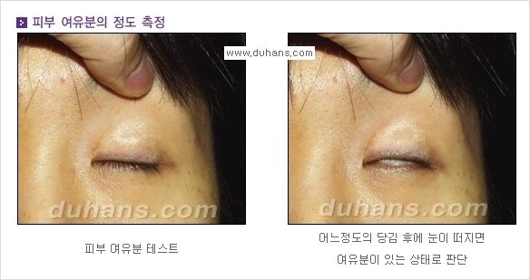 ​[두한성형외과 경쟁력 쌍꺼풀 재수술] - [아름다운 쌍꺼풀 선의 기준과 쌍꺼풀 재수술시 검사와 테스트 안내] 관련 이미지 8