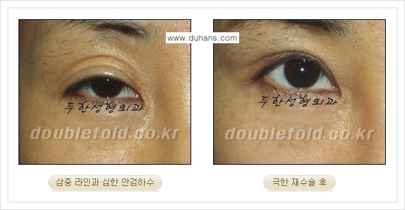 [두한성형외과 경쟁력 쌍꺼풀 재수술] - [극한의 상태에서 쌍꺼풀 재수술 안내 ②] 관련 이미지 15
