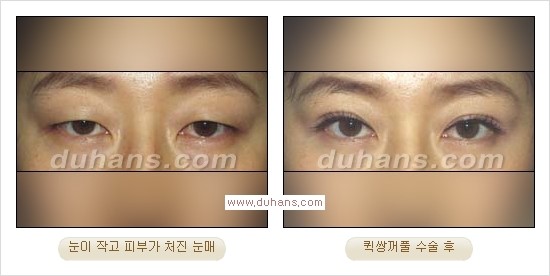 ​[두한성형외과 경쟁력 눈성형] - [자연스럽고 아름다운 쌍꺼풀의 기준] 관련 이미지 19