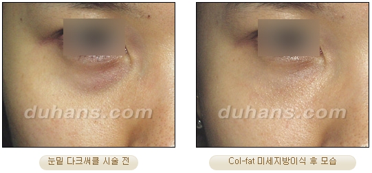 [Duhan Plastic Surgery Facial Autologous Fat Grafting] - [Fat Grafting Guide] image 22