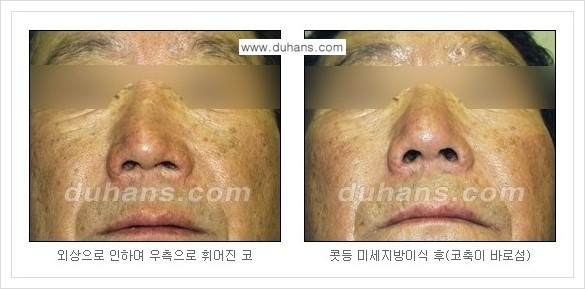 [두한성형외과 경쟁력 코성형] - [자연스러운 코 미세지방이식] 관련 이미지 3