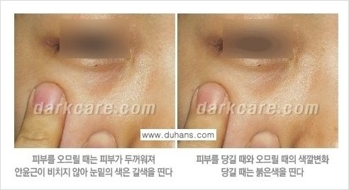 [두한성형외과 경쟁력 눈밑성형] - [다크써클의 원인과 다크써클의 종류] 관련 이미지 3