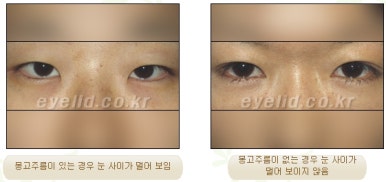 [Duhan Plastic Surgery Eyelid Surgery] - [Epicanthoplasty, Medial Canthoplasty] image 2