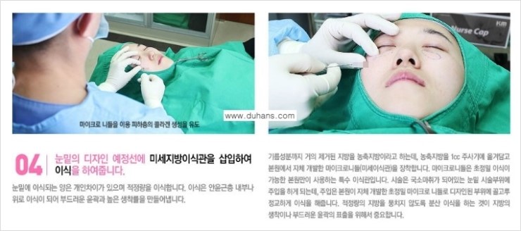 [두한성형외과 FOCUS 눈밑성형] - [다크써클의 치료방법 -  콜펫(Col-fat) 눈밑 미세지방이식 ③] 관련 이미지 9